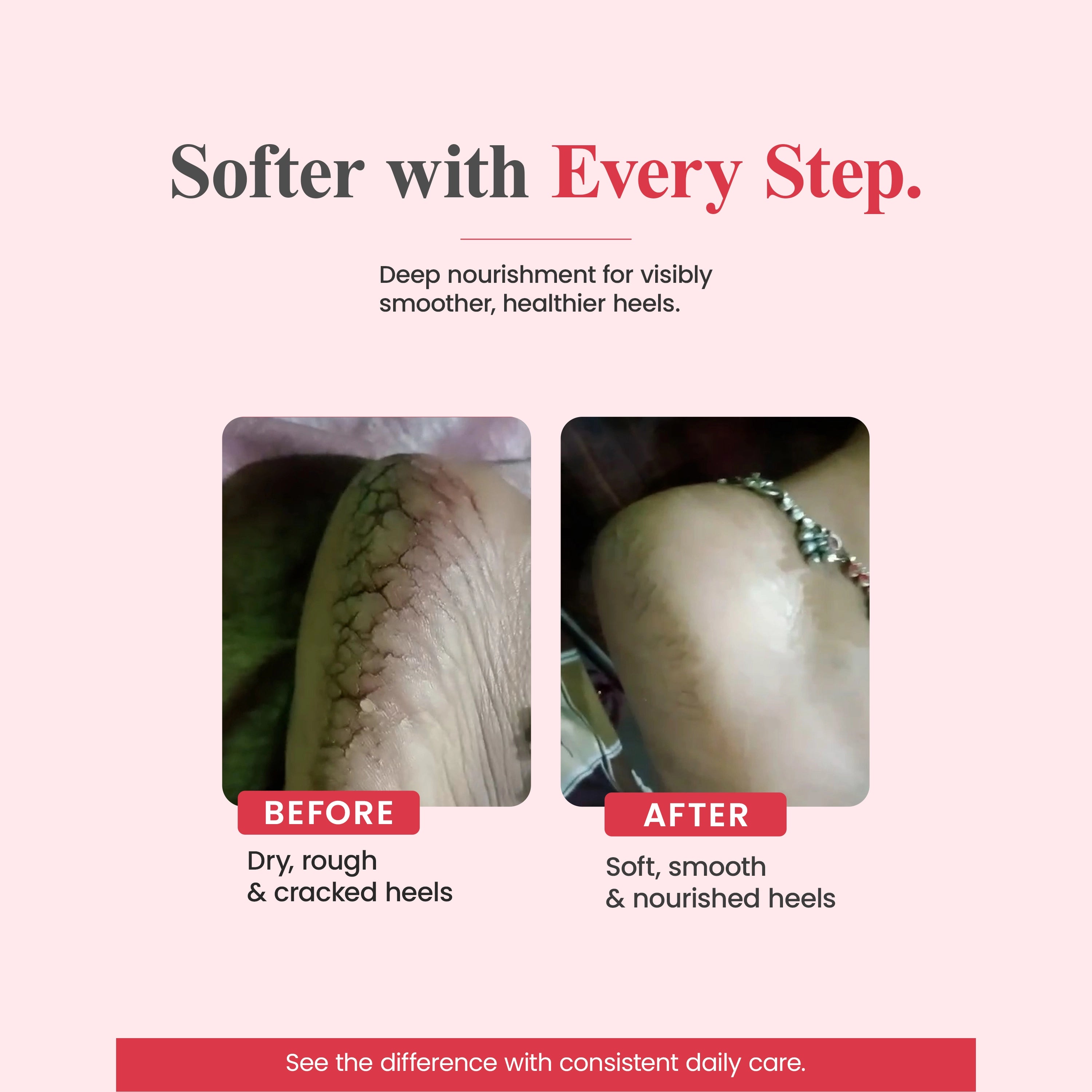 SO-SOFT Foot Care Cream with Natural Active Ingredients- 50g